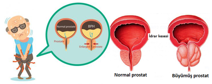 prostatitis hogyan jelenjen meg